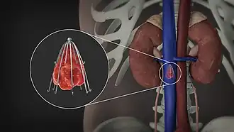 Image showing an inferior vena cava filter in its position