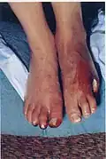 55-year-old female with advanced Buerger's disease on first visit