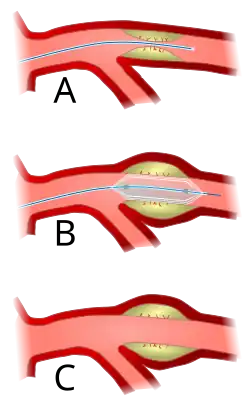 Angioplasty (pictured) and stenting are two endovascular treatments employed by the vascular surgeon.