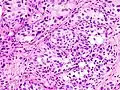 Histopathology of urothelial carcinoma of the urinary bladder.