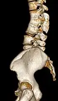 Congenital block vertebra of the lumbar spine. CT volume rendering.
