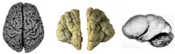 Normal human adult cerebrum (gyrencephaly)(left), polymicrogyria (center) and lissencephaly (right).