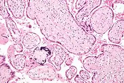 Micrograph of a placental infection (CMV placentitis)
