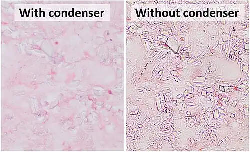 An example of a situation where microscopy without condenser is preferable at high magnification is the evaluation of crystals (calcium pyrophosphate dihydrate crystal deposition disease pictured).