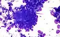 Colorectal adenocarcinoma. Field stain.