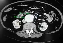 A transverse contrast enhanced CT scan demonstrating an abdominal aortic aneurysm of 4.8 by 3.8&nbsp;cm