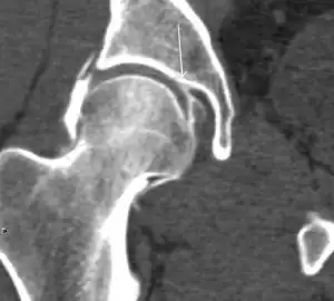 Coronal CT-arthrography (d) showing ligamentum teres tear.[1]