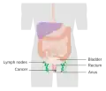 Stage 2 anal cancer