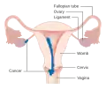Stage 2 choriocarcinoma