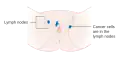 Stage 3 vulvar cancer