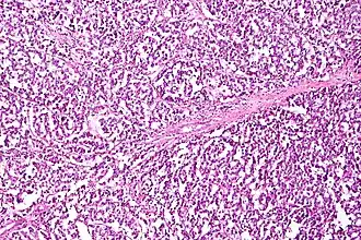 Dysgerminoma characterized by uniform cells separated by fibrous septa with lymphocytes, H&E stain.