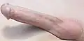 Penis with hypospadias repaired as an adult - side view