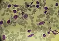 Extracellular and intracellular (macrophages) leishmania parasites in a patient with cutaneous leishmaniasis (May-Grünwald Giemsa x1000).