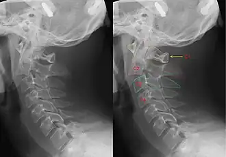 Two x-rays, showing the normal position of the neck, and then a typical break as it would be caused by a hangman's noose