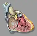 Heart anatomic view of right ventricle and right atrium with example ventricular septal defects
