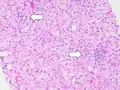 Two foci of lobular inflammation.