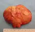 The resected lipoma (8&nbsp;cm × 6&nbsp;cm × 3&nbsp;cm)