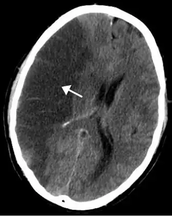 A radiological image of a stroke of the middle cerebral artery
