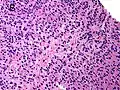 Gleason score 10 (5+5) with cords of cells