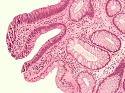 Micrograph of a tubular adenoma&nbsp;– dysplastic epithelium (dark purple) on left of image; normal epithelium (blue) on right. H&E stain.