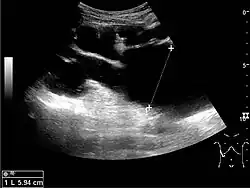 Figure 15. End-stage hydronephrosis with cortical thinning. Measurement of pelvic dilatation on the US image is illustrated by '+' and a dashed line.[1]