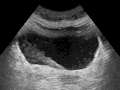 Ultrasound showing a jet of urine entering the bladder (large black section) through the ureter