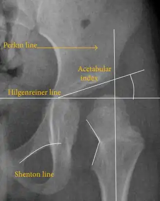Hip dysplasia.[50]