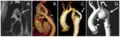 Aortic coarctation using different imaging techniques[28]