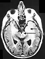 Axial fluid-attenuated inversion recovery MRI image demonstrating tumor-related infiltration involving both temporal lobes (Short arrow), and the substantia nigra (Long arrow).